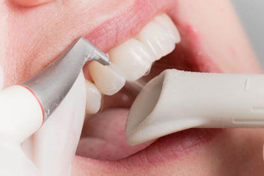 smacchiamento dentale a Verona - Dentista Delazzari