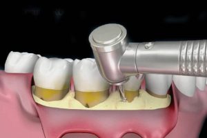 chirurgia paradontale a Verona - Dentista Delazzari