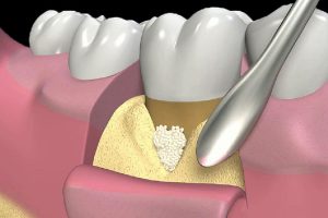 chirurgia rigenerativa a Verona - Dentista Delazzari