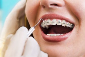 ortodonzia fissa a Verona - Dentista Delazzari